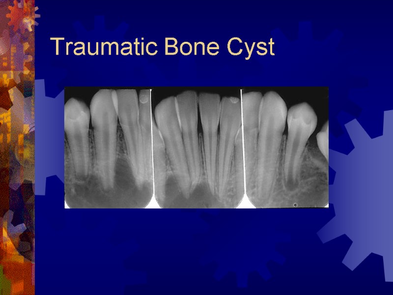 Traumatic Bone Cyst